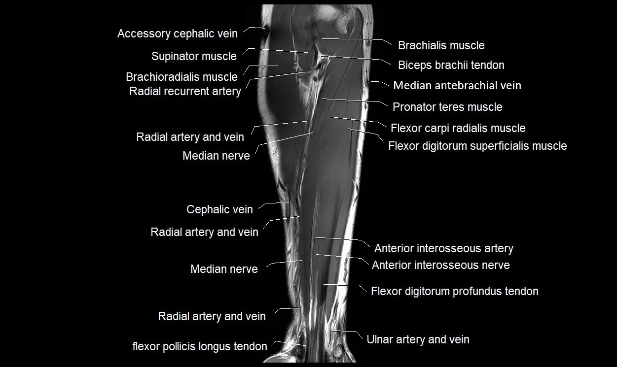MRI 3T forearm coronal cross sectional anatomy image 8.webp